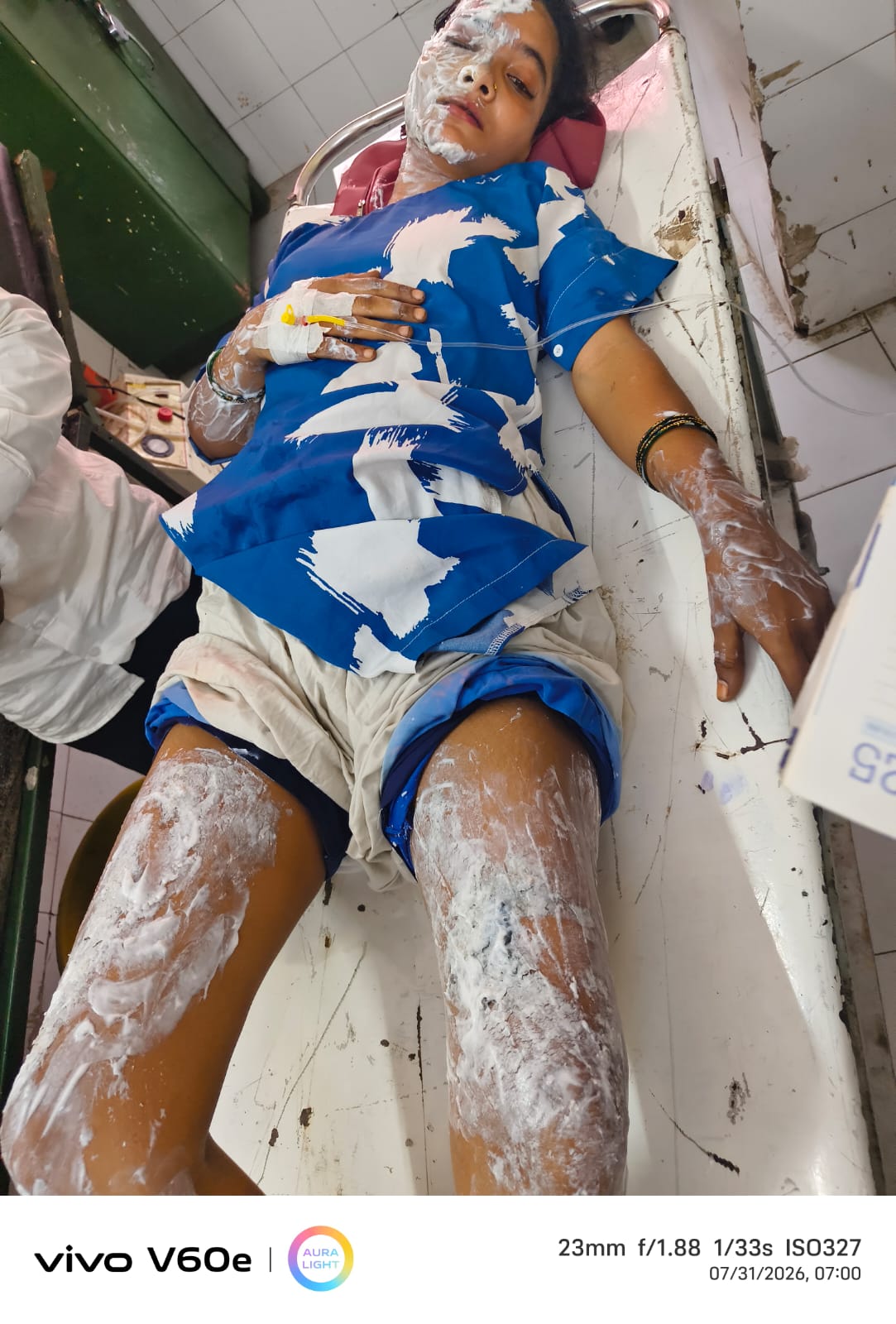 Husband throws acid on wife in Aligarh, woman hospitalized